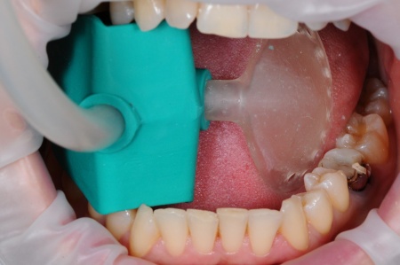 Аспирационно ретракционная система Freestom solid размер M
